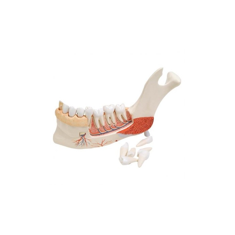 3B Scientific, modello anatomico di metà della mandibola con 8 denti cariati VE290