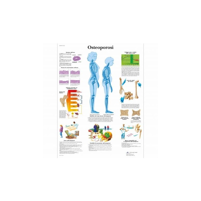 3B Scientific, tavola anatomica, Poster Osteoporosi (cod. VR4121L)