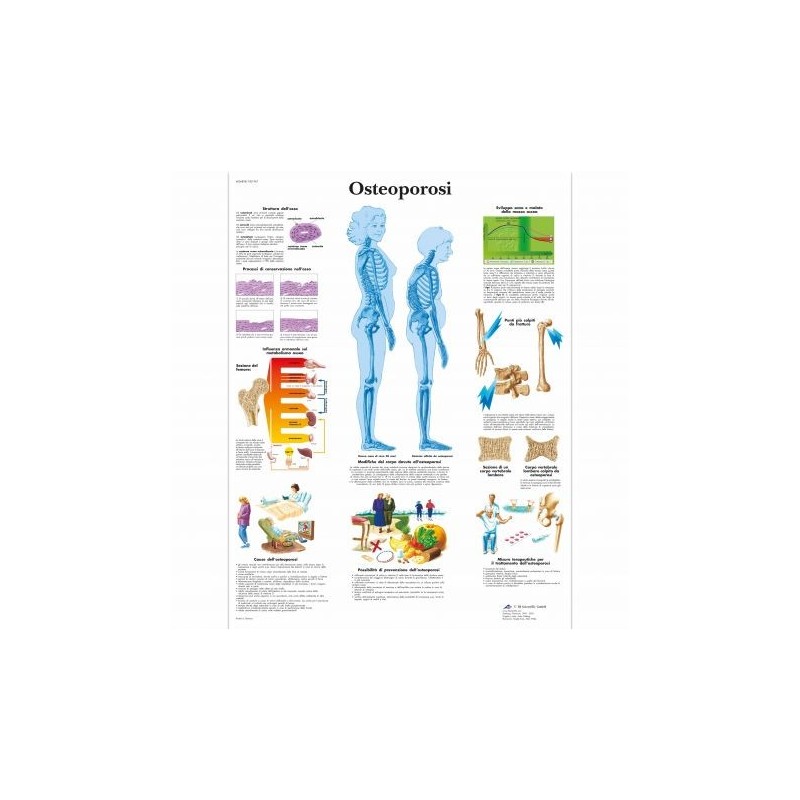 3B Scientific, tavola anatomica, Poster Osteoporosi (cod. VR4121UU)