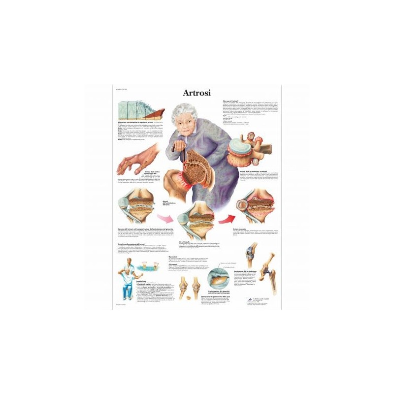 3B Scientific, tavola anatomica, Poster Artrosi  (cod. VR4123L)