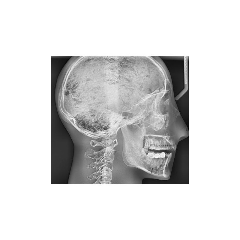 Simulatore per radiologia - Cranio con vertebre cervicali - Trasparente - Erler Zimmer 7300