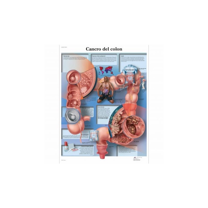 3B Scientific, tavola anatomica, Poster Cancro del Colon cod. VR4432UU