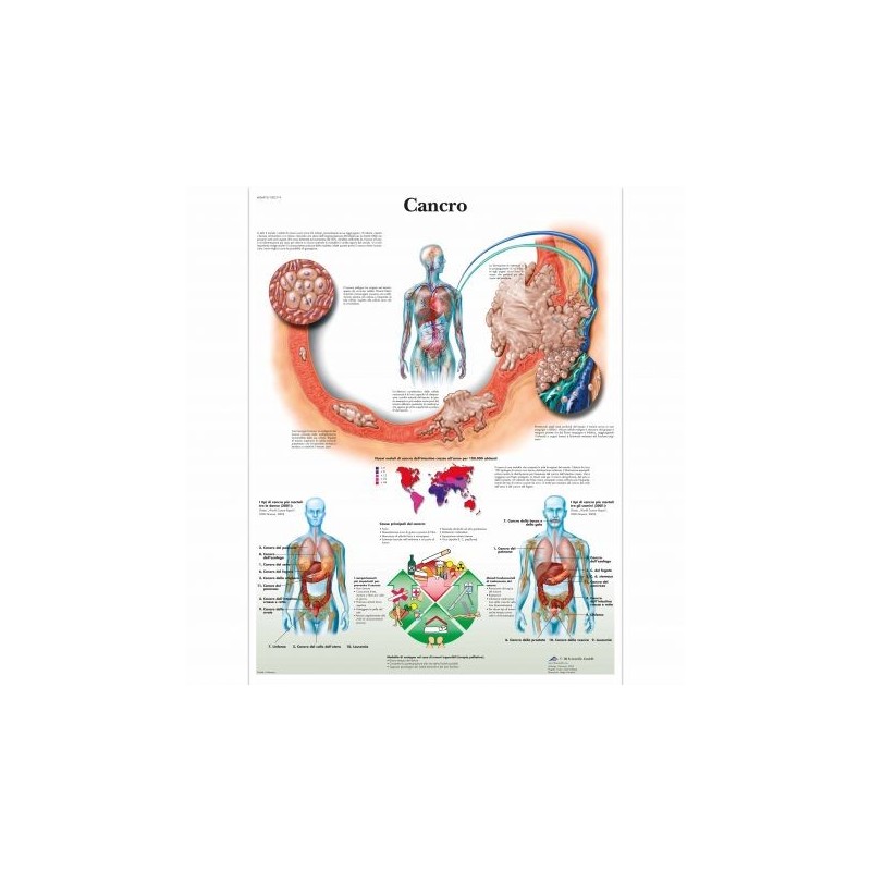 3B Scientific, tavola anatomica, Poster Cancro cod. VR4753UU