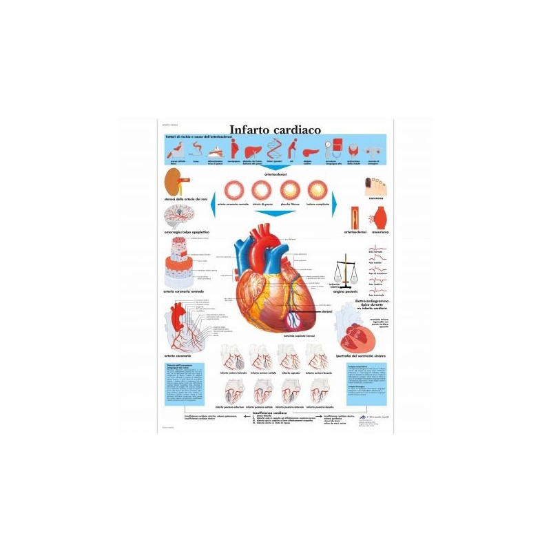 3B Scientific, tavola anatomica, Infarto Cardiaco (cod, VR4342UU)